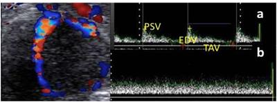 Histological and hemodynamic characterization of corpus luteum throughout the luteal phase in pregnant and non-pregnant buffalos in relation to nitric oxide levels based on its anatomical determination